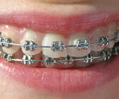 גשר לשיניים ליישור שיניים - אורטודנטיה