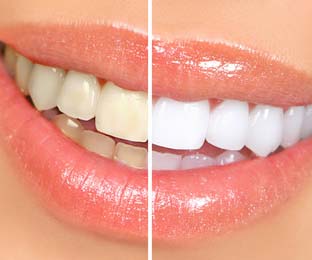 הלבנת שיניים, הלבנת שיניים ערכה ביתית, הלבנת שיניים בלייזר, הלבנת שיניים בליזר